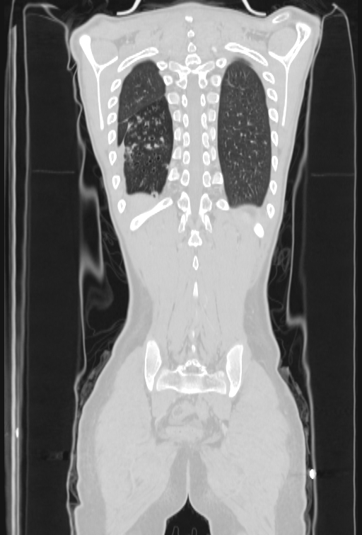 Bronchial carcinoid tumor (Radiopaedia 57187-64090 Coronal lung window 96).jpg