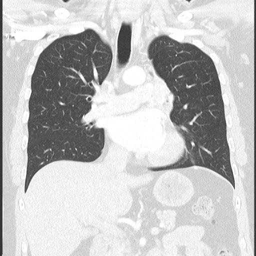 Bronchial carcinoid tumor (Radiopaedia 67377-76764 Coronal lung window 35).jpg
