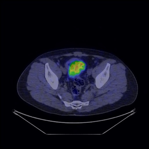 Bronchial carcinoid tumor (Radiopaedia 67377-76765 68Ga-DOTATATE PET-CT 68).jpg