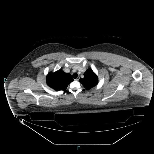 Bronchial carcinoid tumor (Radiopaedia 78272-90870 C 27).jpg