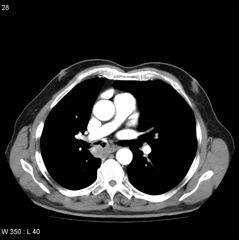 Bronchial carcinoid tumor with right lower lobe collapse (Radiopaedia 29060-29422 A 27).jpg