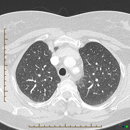 Bronchial diverticula (Radiopaedia 79512-92676 Axial lung window 42).jpg