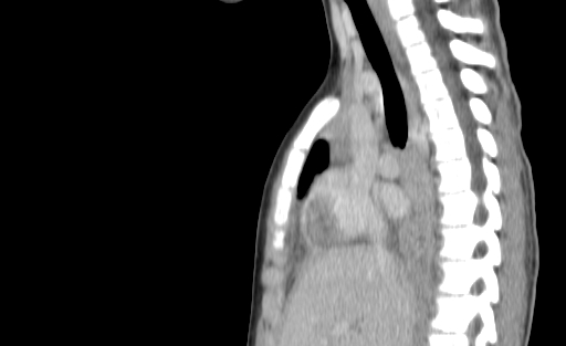 Bronchial mucoepidermoid carcinoma (Radiopaedia 57023-63895 Sagittal 102).jpg