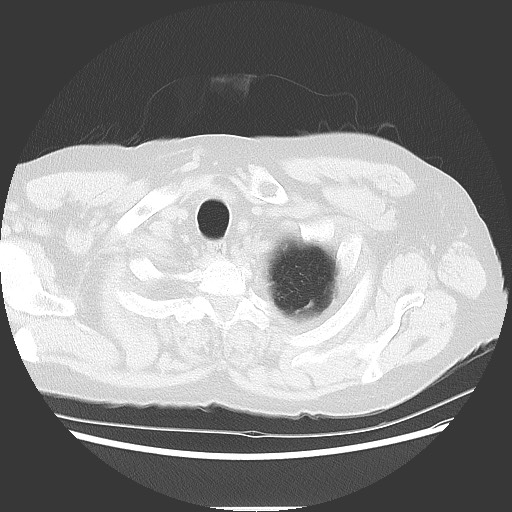Bronchial stenosis - lung transplant (Radiopaedia 73133-83848 Axial lung window 7).jpg