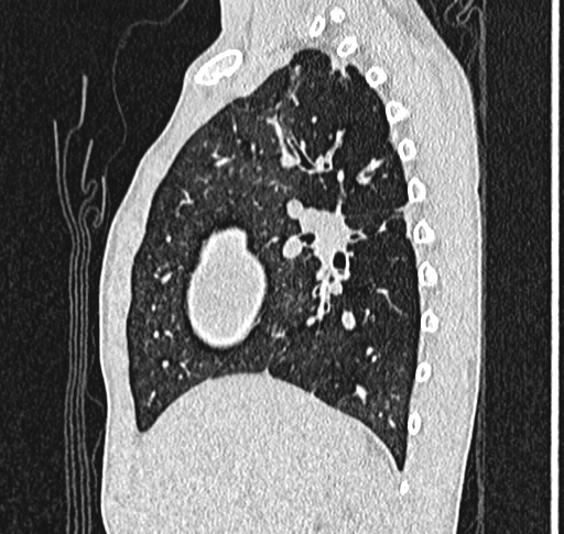 Bronchiolitis obliterans (Radiopaedia 71538-81897 Sagittal lung window 22).jpg