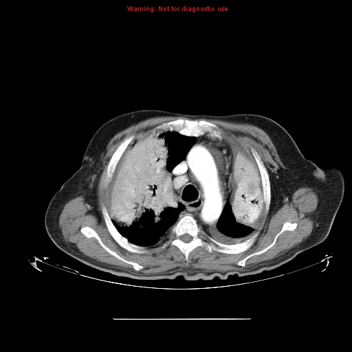 File:Bronchioloalveolar carcinoma (Radiopaedia 9272-9955 A 9).jpg