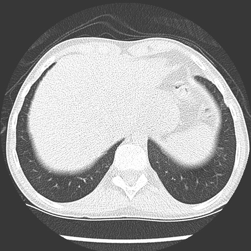Bronchiolotis obliterans (Radiopaedia 73769-84575 Axial lung window 42).jpg