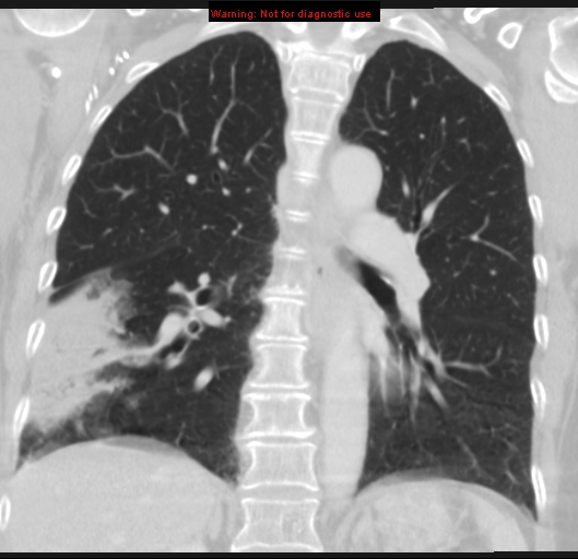 Bronchoalveolar carcinoma (BAC) (Radiopaedia 13436-13392 Coronal lung window 35).jpg