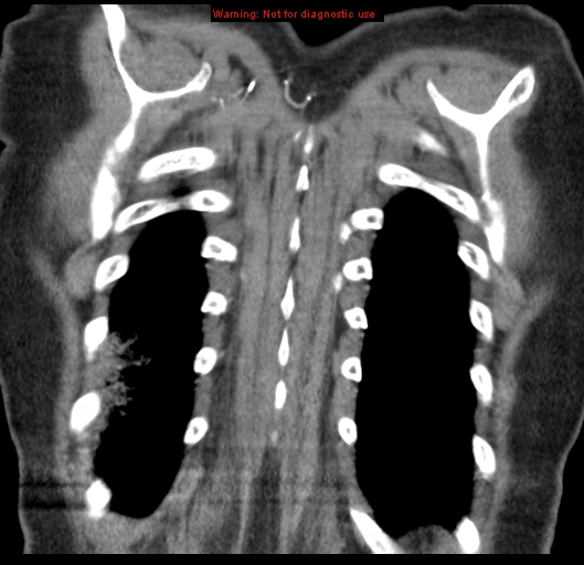 File:Bronchoalveolar carcinoma (BAC) (Radiopaedia 13436-13392 E 54).jpg