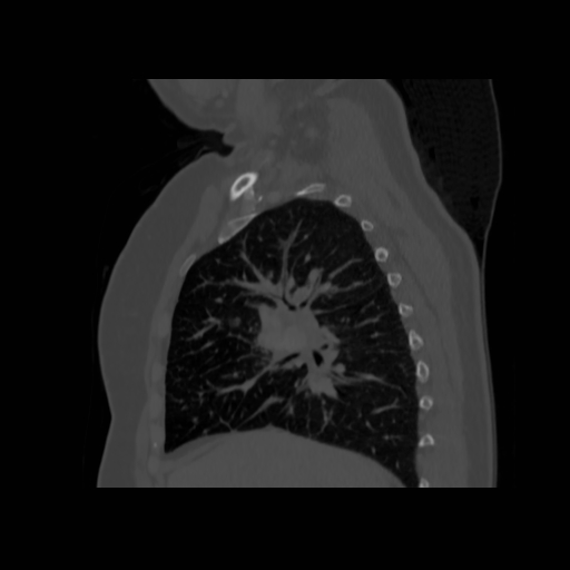 Bronchogenic carcinoma (Radiopaedia 73497-84262 Sagittal bone window 63).jpg