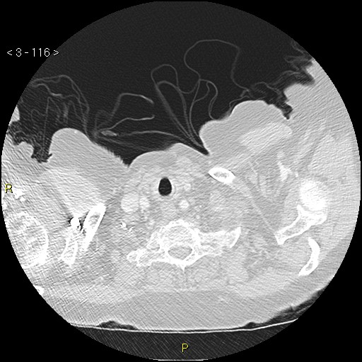 File:Bronchogenic carcinoma as an incidental finding (Radiopaedia 16453-16130 Axial lung window 116).jpg
