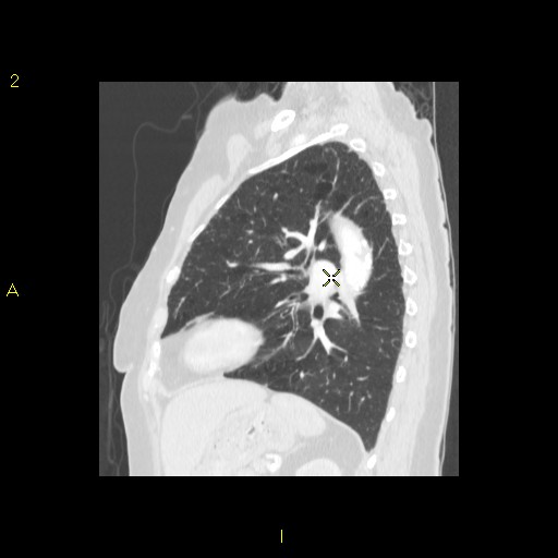 File:Bronchogenic carcinoma as an incidental finding (Radiopaedia 16453-16130 Sagittal lung window 18).jpg