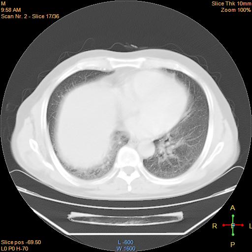 File:Bronchogenic carcinoma with superior vena caval invasion (Radiopaedia 22378-22406 lung window 14).jpg