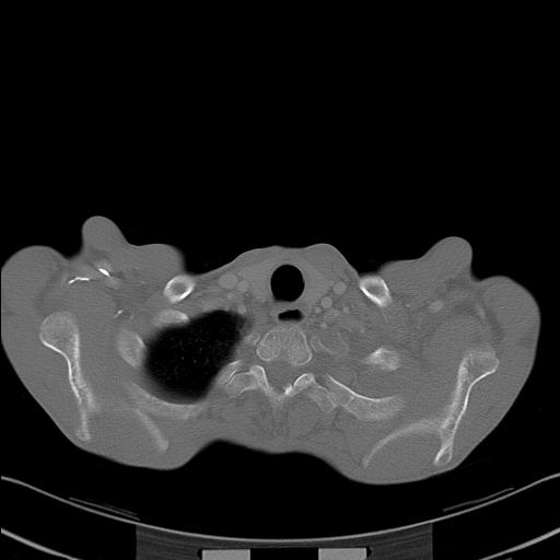 File:Bronchopleural fistula secondary to tuberculosis (Radiopaedia 20415-20322 Axial bone window 4).jpg