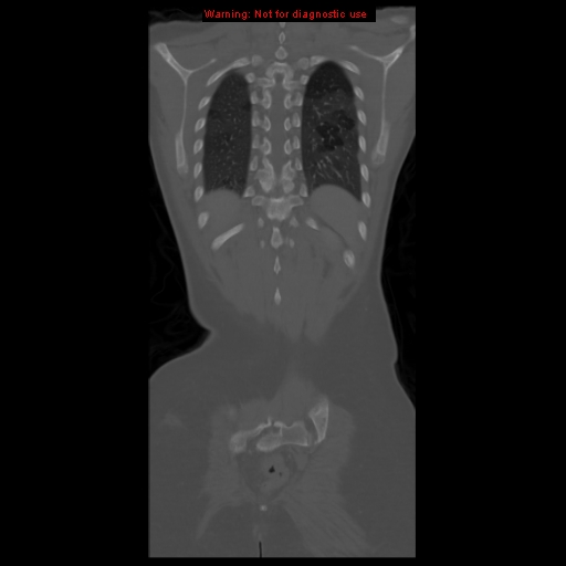 Brown tumor (Radiopaedia 12318-12596 D 55).jpg