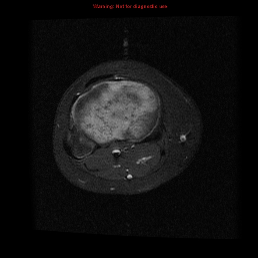 File:Brown tumor (Radiopaedia 12318-12597 Axial T1 C+ fat sat 13).jpg