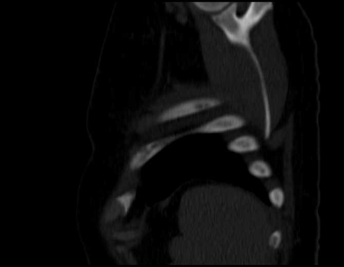 Brown tumors compressing the spinal cord (Radiopaedia 68442-77988 Sagittal bone window 51).jpg