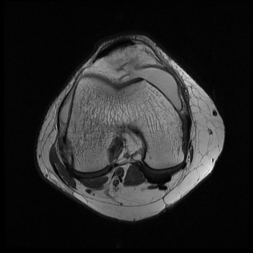 File:Bucket handle meniscus tear (Radiopaedia 56916-63751 Axial PD 9).jpg