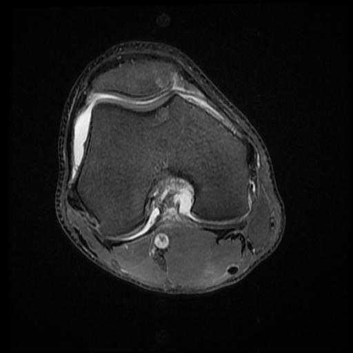 File:Bucket handle tear - medial meniscus (Radiopaedia 69245-79026 Axial PD fat sat 8).jpg