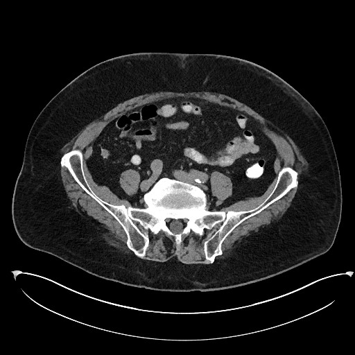Buried bumper syndrome - gastrostomy tube (Radiopaedia 63843-72577 Axial Inject 87).jpg