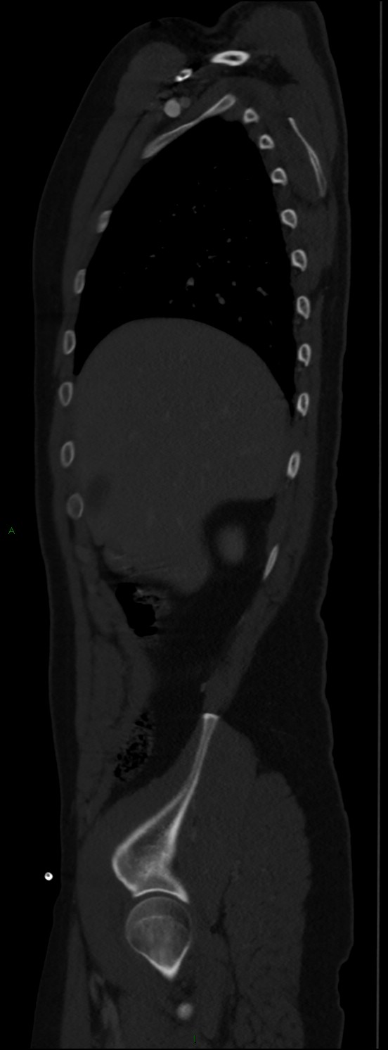 Burst fracture (Radiopaedia 83168-97542 Sagittal bone window 38).jpg