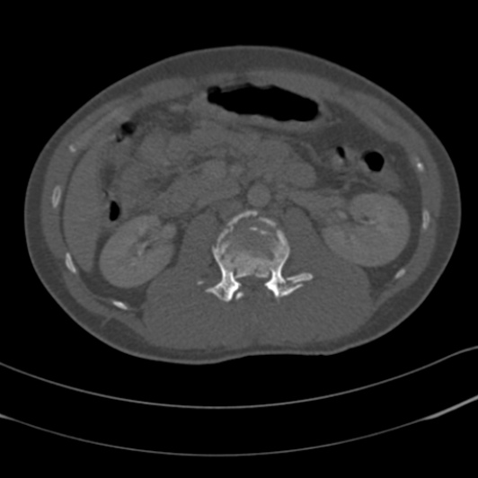Burst fracture with cauda equina syndrome (Radiopaedia 25701-25867 Axial bone window 34).jpg