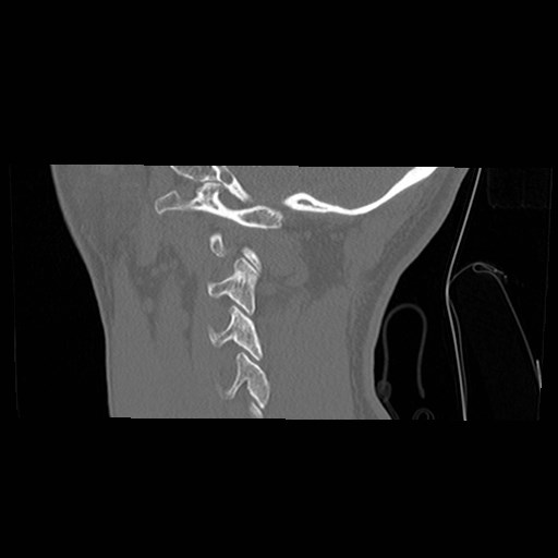 C1-C2 "subluxation" - normal cervical anatomy at maximum head rotation (Radiopaedia 42483-45607 C 9).jpg