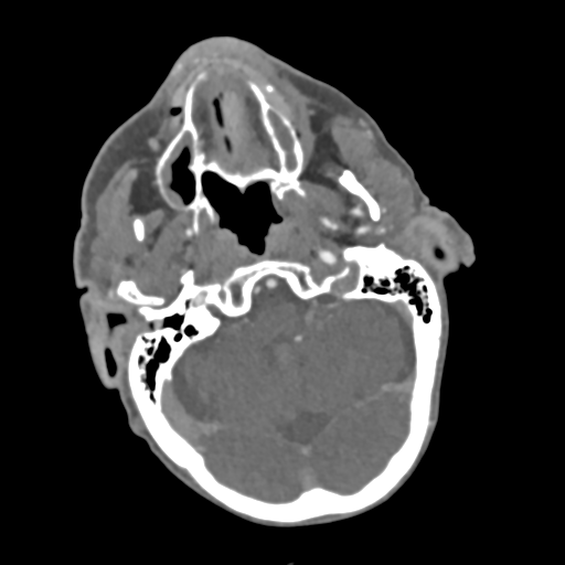 File:C2 fracture with vertebral artery dissection (Radiopaedia 37378-39200 A 201).png