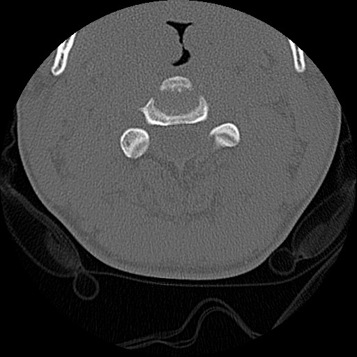 File:C5 facet fracture (Radiopaedia 58374-65499 Axial bone window 31).jpg