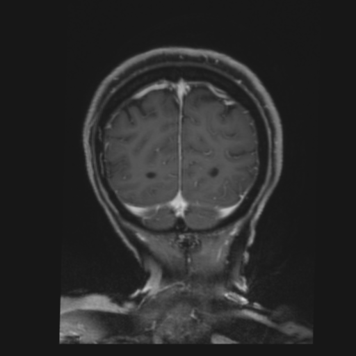 CNS lymphoma with steroid response (Radiopaedia 37980-39921 Coronal T1 C+ 43).png