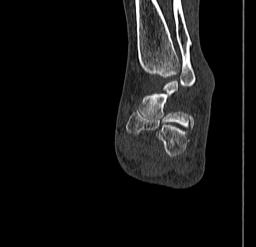 Calcaneal fracture - Sanders type 4 (Radiopaedia 90179-107370 Coronal bone window 58).jpg