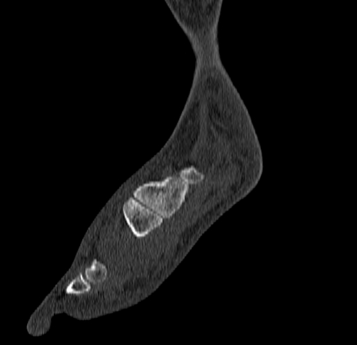 Calcaneal fracture - Sanders type 4 (Radiopaedia 90179-107370 Sagittal bone window 27).jpg