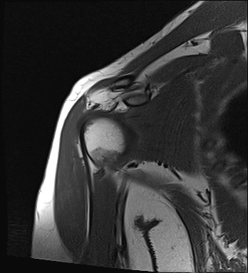 File:Calcific tendinitis of the infraspinatus tendon (Radiopaedia 87256-103537 Coronal T1 8).jpg