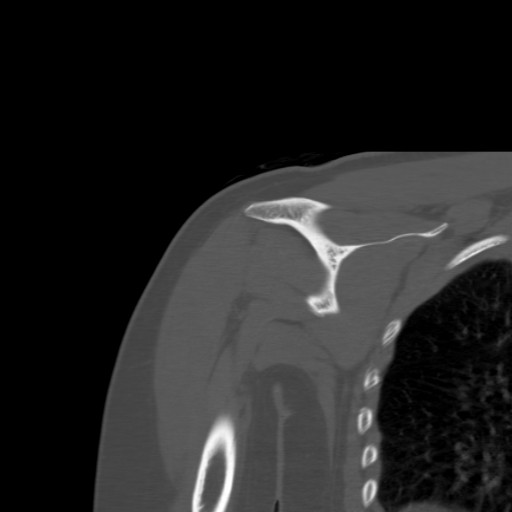 File:Calcific tendinitis of the infraspinatus tendon (Radiopaedia 87256-103539 Coronal bone window 35).jpg