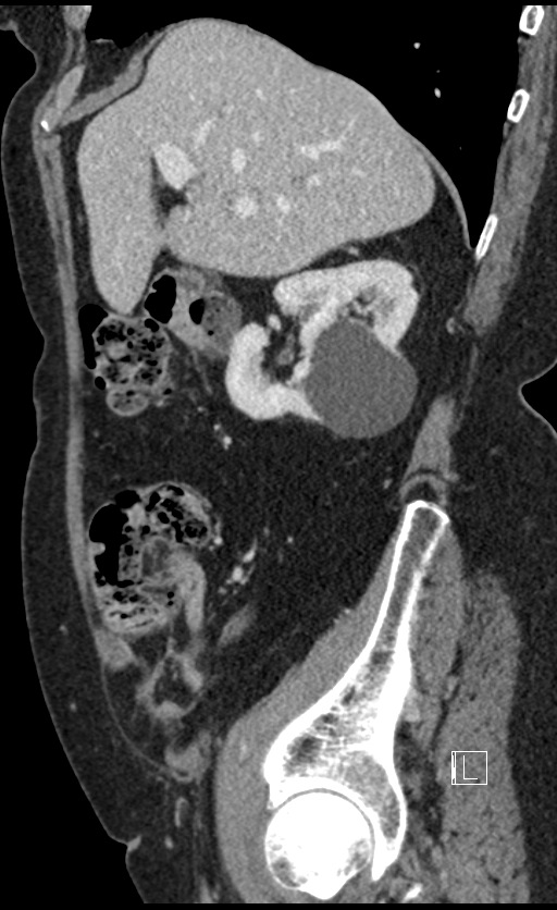 Calcified adrenal glands and Spigelian hernia (Radiopaedia 49741-54988 C 118).jpg