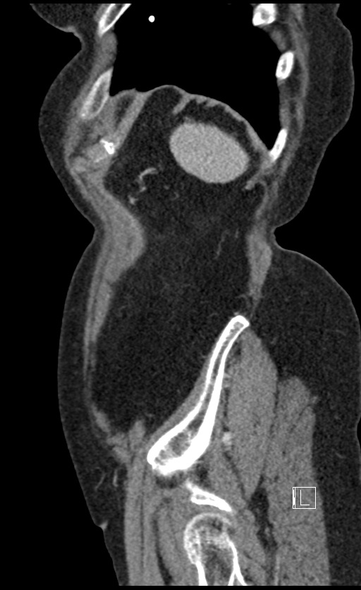 Calcified adrenal glands and Spigelian hernia (Radiopaedia 49741-54988 C 22).jpg