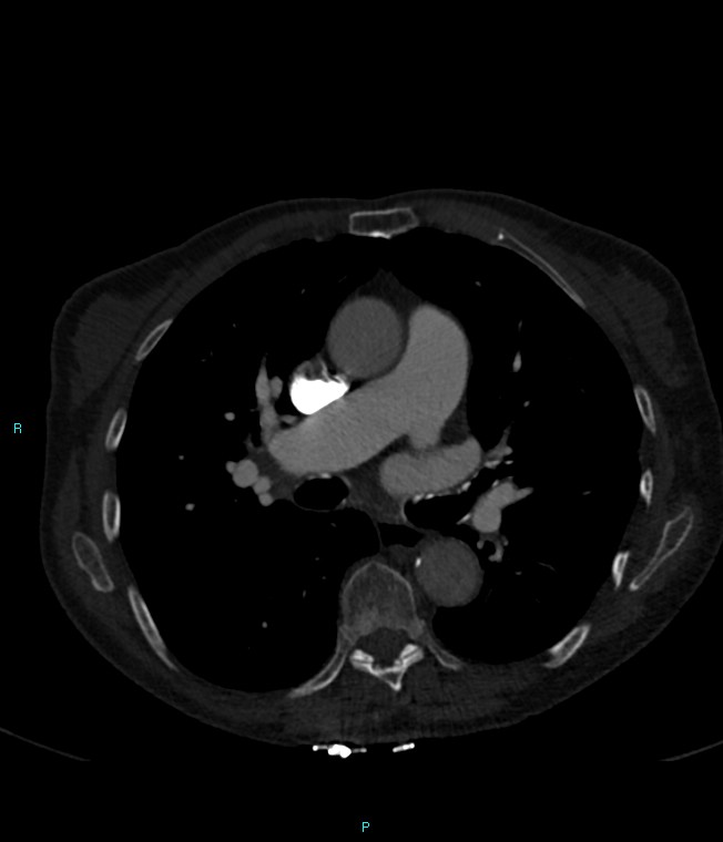 Calcified cerebral emboli from left ventricular thrombus (Radiopaedia 84420-99760 Axial bone window 37).jpg