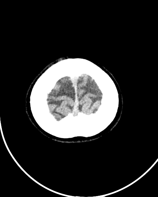 Calcified meningioma (Radiopaedia 74361-85243 Axial non-contrast 4).jpg