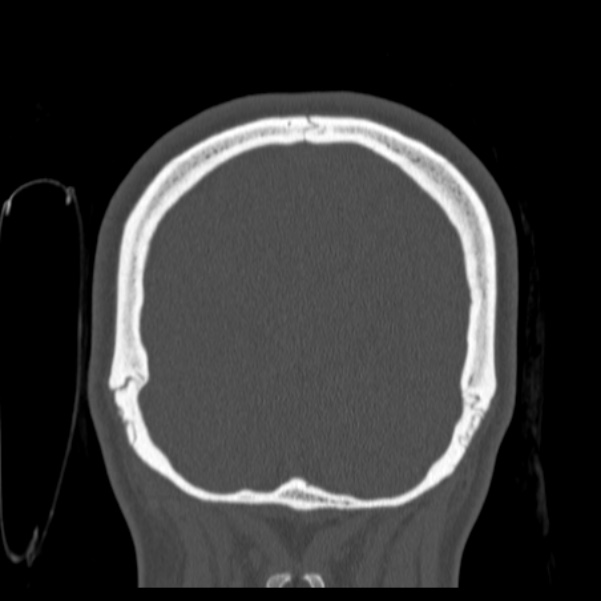 Calvarial osteoma (Radiopaedia 36520-38079 C 78).jpg