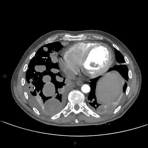 File:Cannonball metastases (Radiopaedia 82110-96150 Axial C+ CTPA 234).jpg