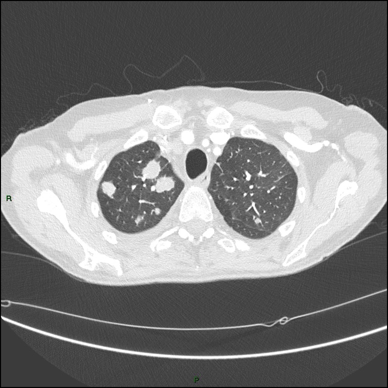 Cannonball metastases (Radiopaedia 82110-96150 Axial lung window 46).jpg