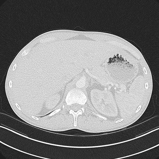 Cannonball metastases - testicular choriocarcinoma (Radiopaedia 84510-99891 Axial lung window 93).jpg