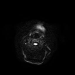 Carcinoma ex-pleomorphic adenoma of parotid (Radiopaedia 28383-28627 Ax DWI B-500 GE 42).jpg