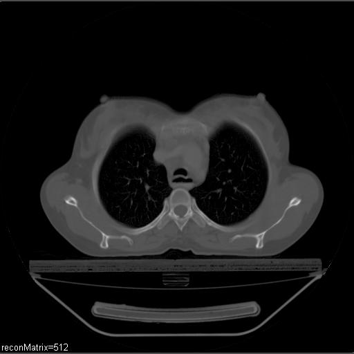File:Carcinoma of esophagus (Radiopaedia 27356-27550 Axial bone window 25).jpg