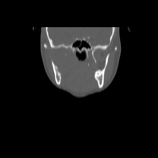 Carcinoma of the maxillary antrum (Radiopaedia 53805-59888 Coronal bone window 62).jpg
