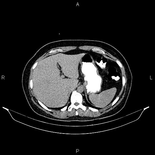 File:Carcinoma of uterine cervix (Radiopaedia 85861-101700 Axial C+ delayed 4).jpg