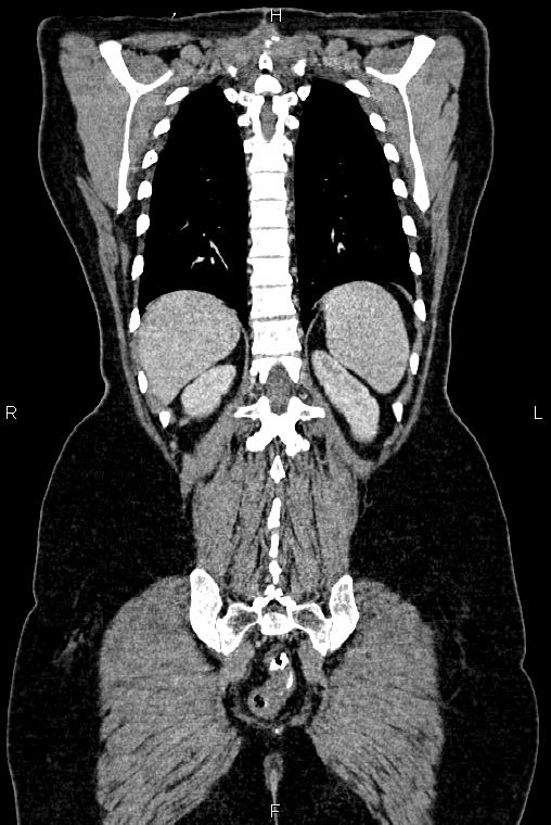 Carcinoma of uterine cervix (Radiopaedia 85861-101700 C 47).jpg