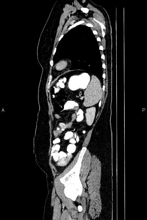 Carcinoma of uterine cervix (Radiopaedia 85861-101700 D 70).jpg