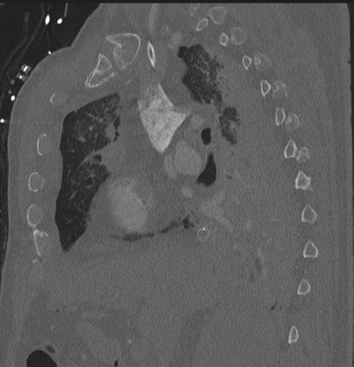 Cardiac trauma (Radiopaedia 32874-33858 Sagittal bone window 65).jpg
