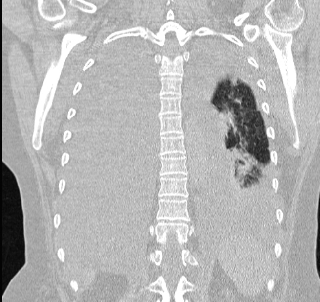 Cardiogenic pulmonary edema (Radiopaedia 29213-29609 Coronal lung window 51).jpg